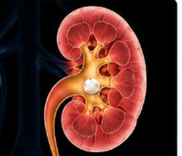 Kidney Stones (Renal Calculi)
